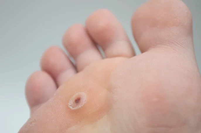 Olho de Peixe (Verruga Plantar)